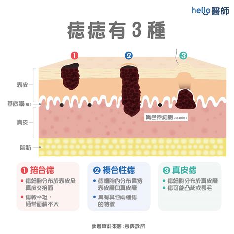 三星痣長怎樣|痣形成的原因？痣長毛、痣變多變大是痣病變？5招判。